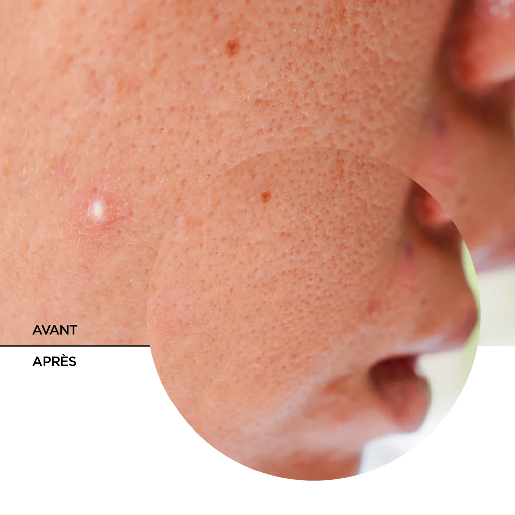 REVOX B77 JUST SUCCINIC ACID SPOT TREATMENT,