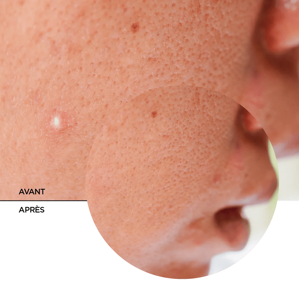 REVOX B77 JUST SUCCINIC ACID SPOT TREATMENT, - Revox | BeautyForYou.ma