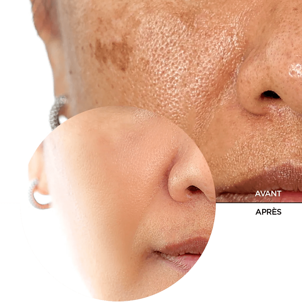 REVOX B77 SKINTREATS BIOTIC RESURFACING ACTIVATOR, 30 ml - Revox | BeautyForYou.ma